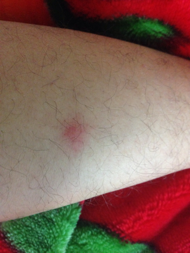 我想知道这个小红点儿是被什么虫子咬的?不疼