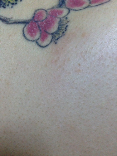 身上长了好多麻麻赖赖的小包,还会很痒,期间用