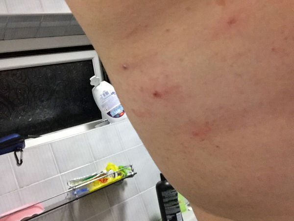 最近身上长疙瘩 特别痒 不知道是怎么回事。是