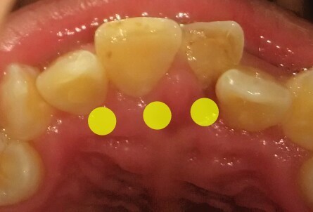 点的3颗牙做过根管治疗(到了封药那一步),左1,