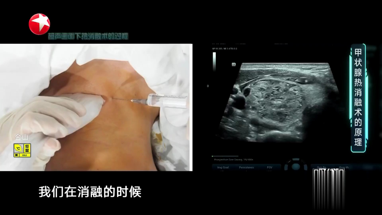 名医话养生 甲状腺结节的高发人群