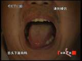 健康之路 “猛人”老王