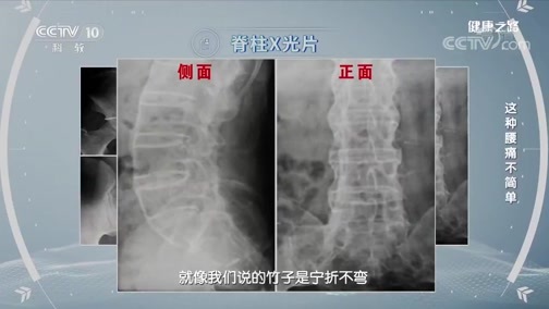 健康之路 《健康之路》 20200325 这种腰痛不简单