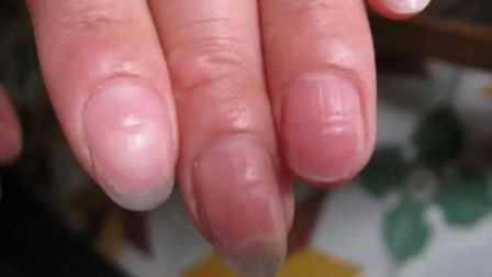 健康之路 指甲有这些情况要小心病症找上身