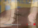 健康之路 身体“长”针之谜