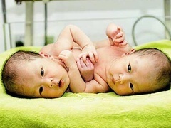 经典传奇 连体小姐妹的分离奇迹
