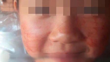 女孩得怪病 流汗像流血 神似汗血马