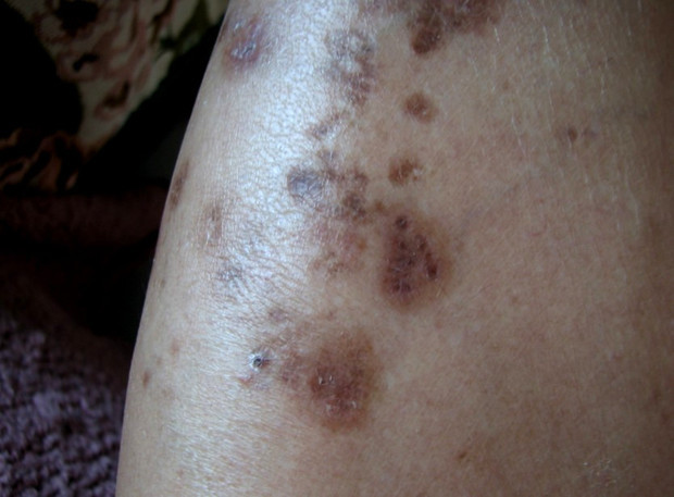 是碰破了,好了后就留下褐色的疤痕,不疼,没有任何感觉只是很难看不敢