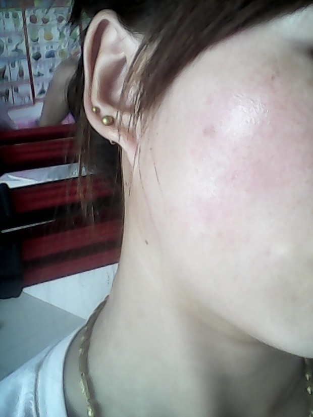 得扁平疣3年了最近4个月才治疗,就脸上有,看着好像有点淡了这是要下去