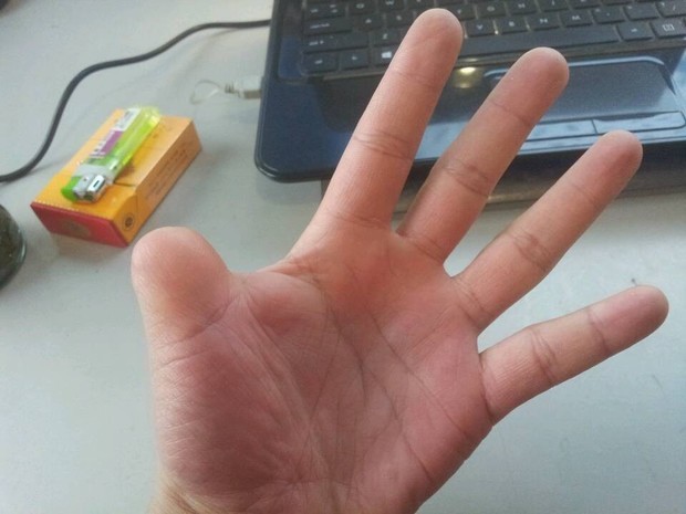 本人左手大母指有半截缺失,请问成都有可以考取驾照吗?