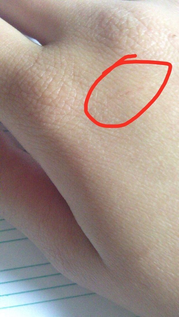 手被狗咬破了点皮