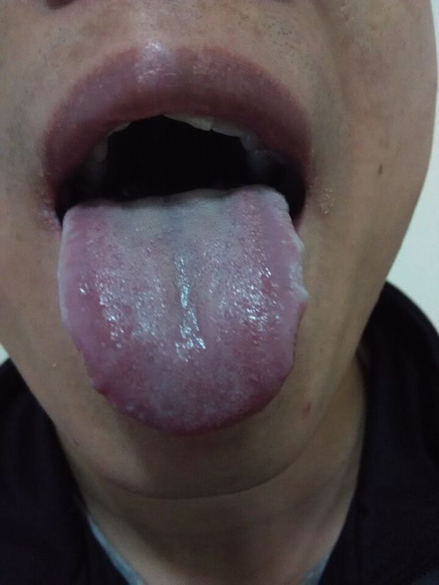消化不良,舌苔白,有齿痕