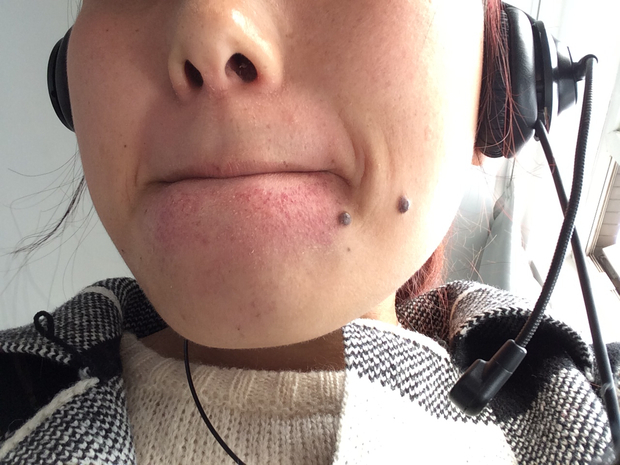 一顿午饭吃过下巴全是红点点,中午吃了泡沫 火腿肠,瓜子,生花生 小块